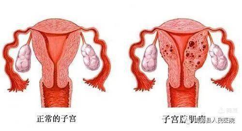 子宫肌瘤最佳治疗方案探讨